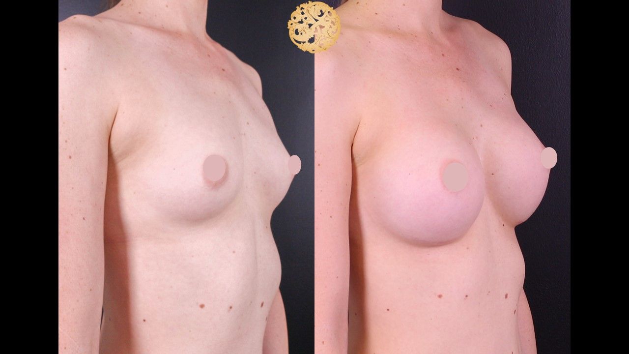 Breast Augmentation Before & After