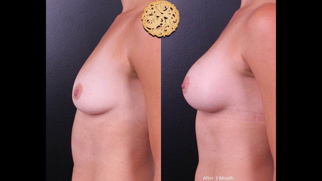 Breast Augmentation Before & After