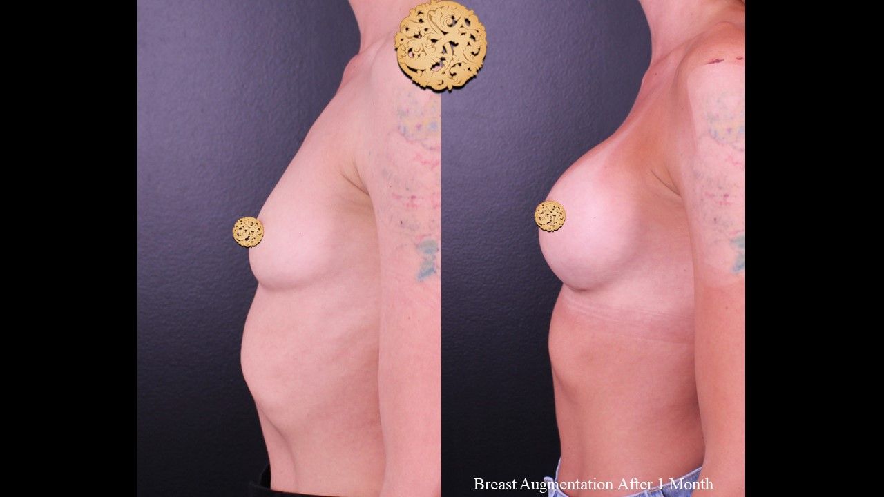 Breast Augmentation Before & After