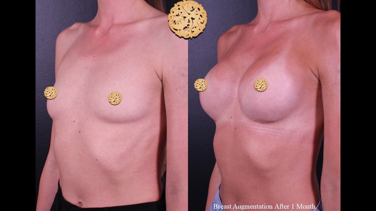 Breast Augmentation Before & After