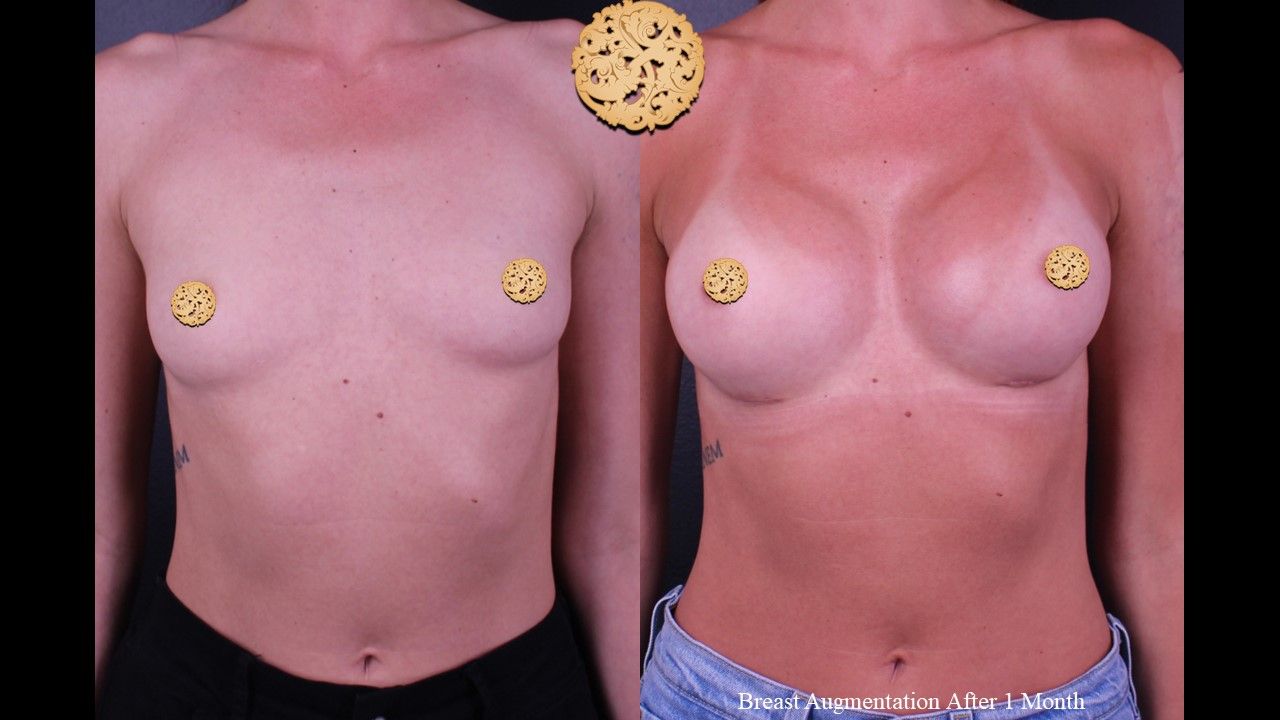 Breast Augmentation Before & After