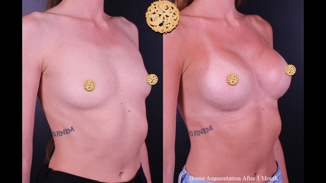 Breast Augmentation Before & After