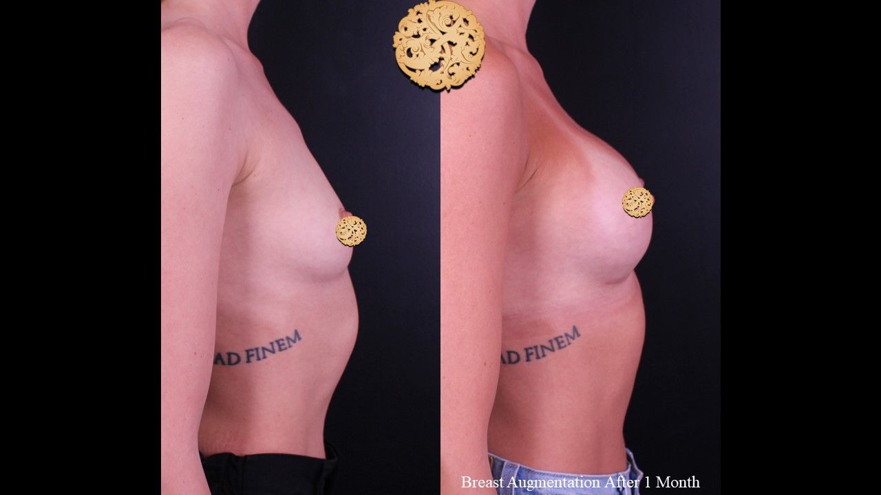 Breast Augmentation Before & After