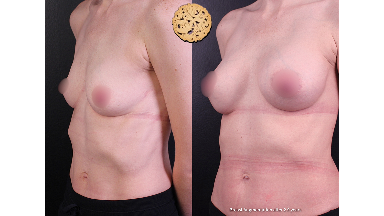 Before and after breast augmentation results comparison.