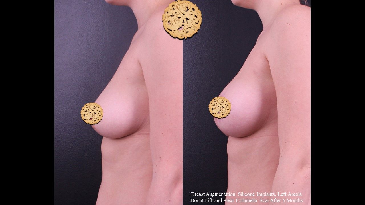 Breast Augmentation Before & After