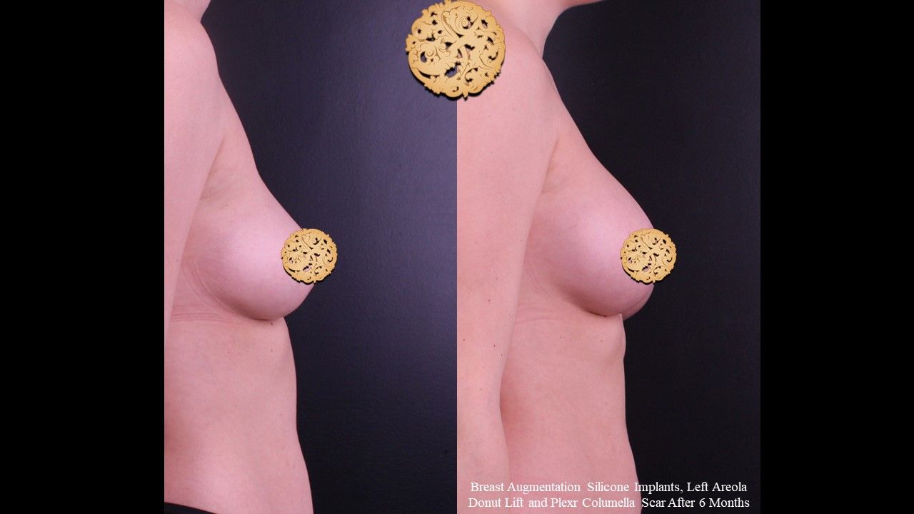 Breast Augmentation Before & After