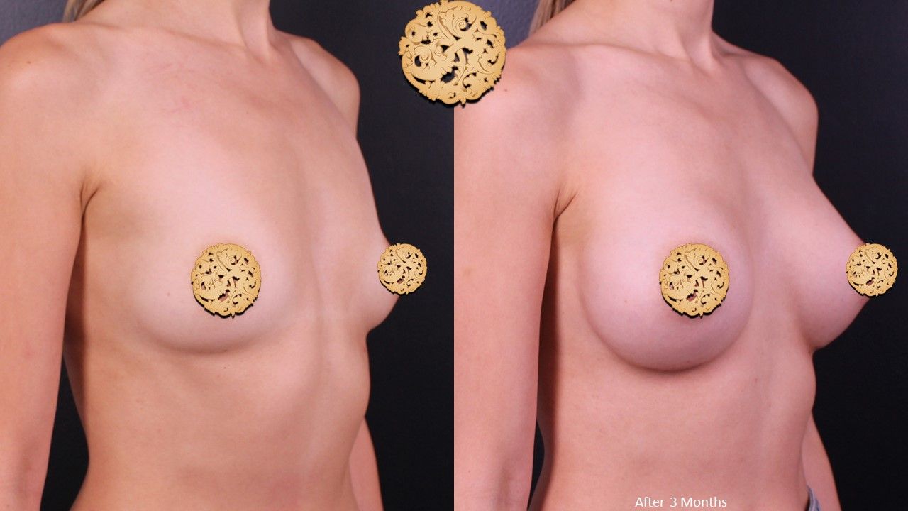 Breast Augmentation Before & After