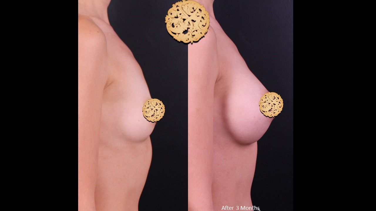 Breast Augmentation Before & After
