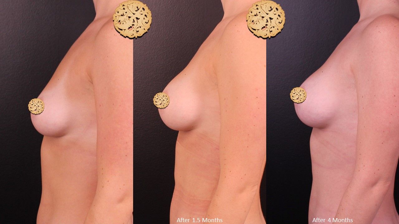 Breast Augmentation Before & After
