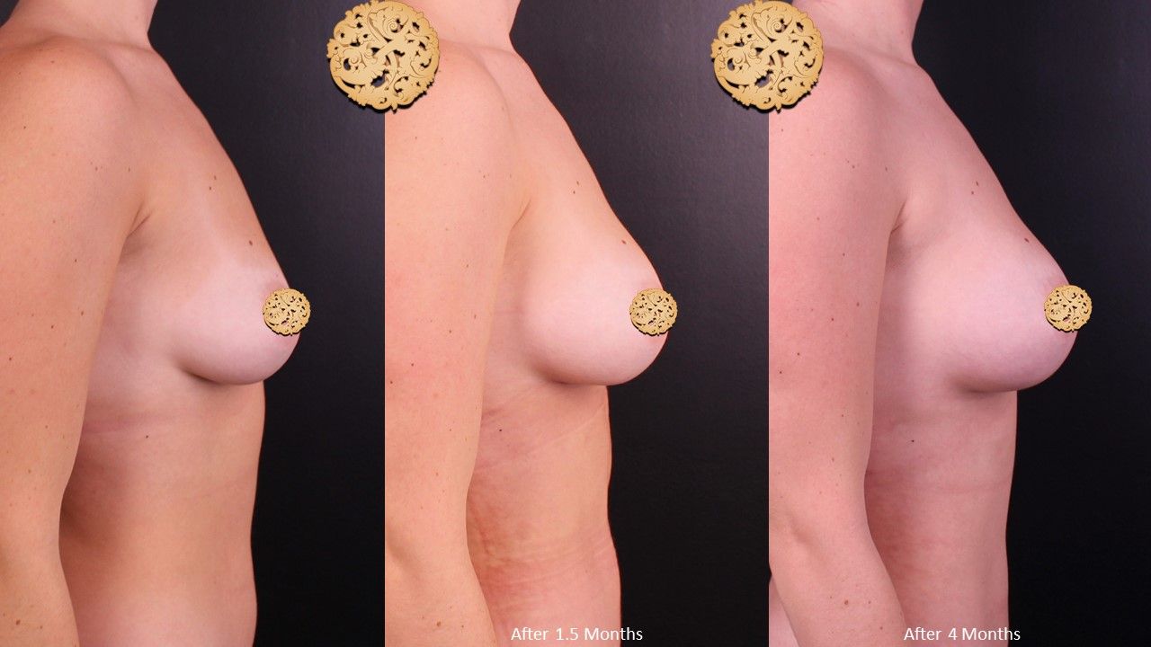 Breast Augmentation Before & After