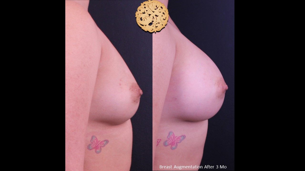 Breast Augmentation Before & After