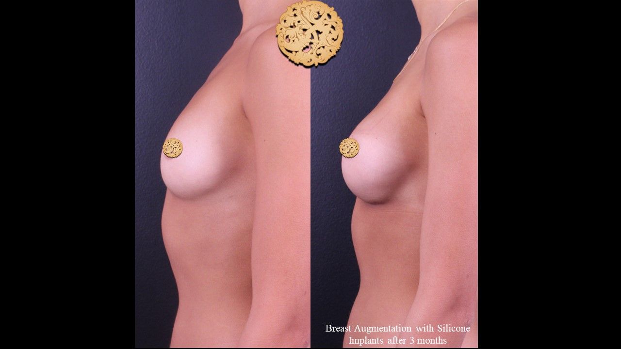 Breast Augmentation Before & After