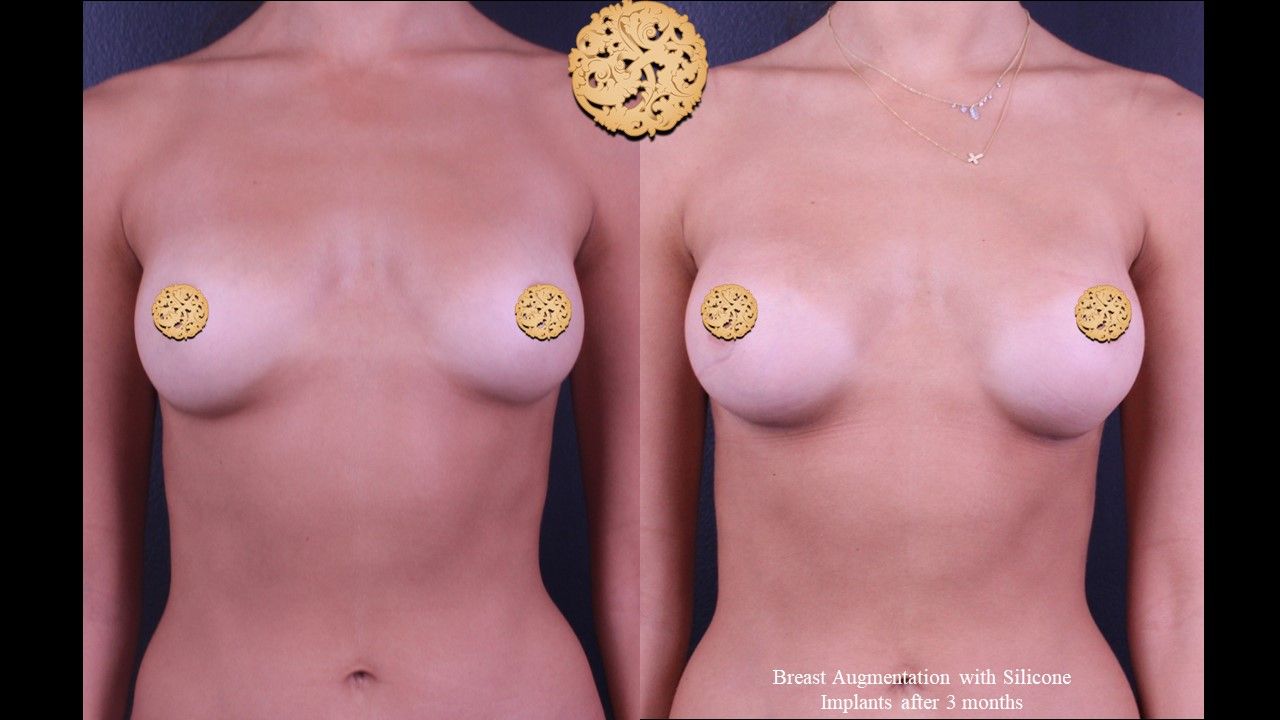 Breast Augmentation Before & After