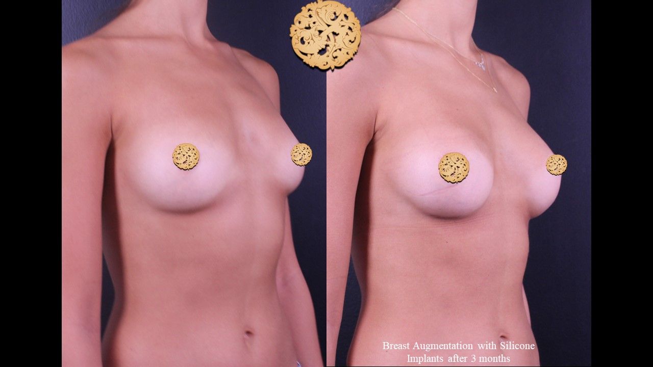 Breast Augmentation Before & After
