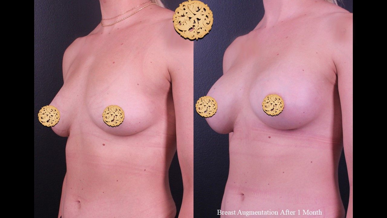 Breast Augmentation Before & After