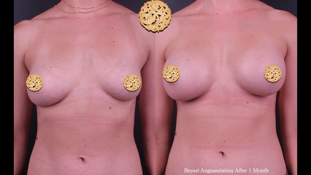 Breast Augmentation Before & After