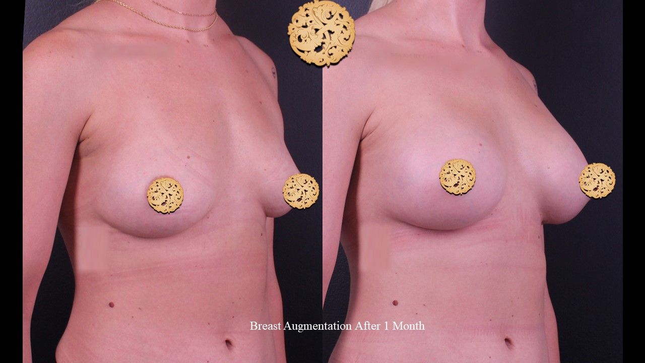 Breast Augmentation Before & After