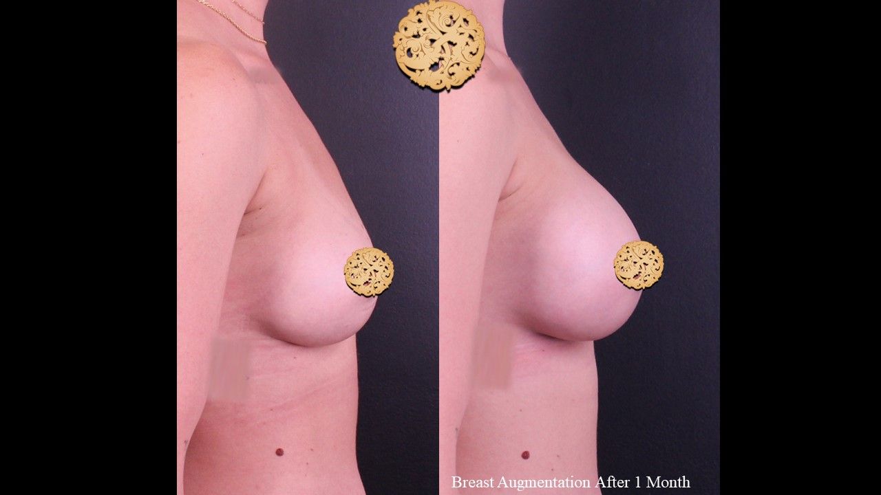 Breast Augmentation Before & After