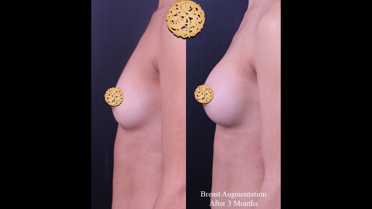 Breast Augmentation Before & After