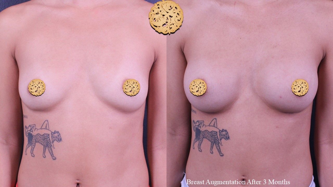 Breast Augmentation Before & After