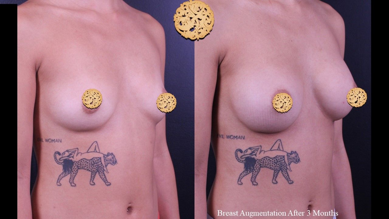 Breast Augmentation Before & After