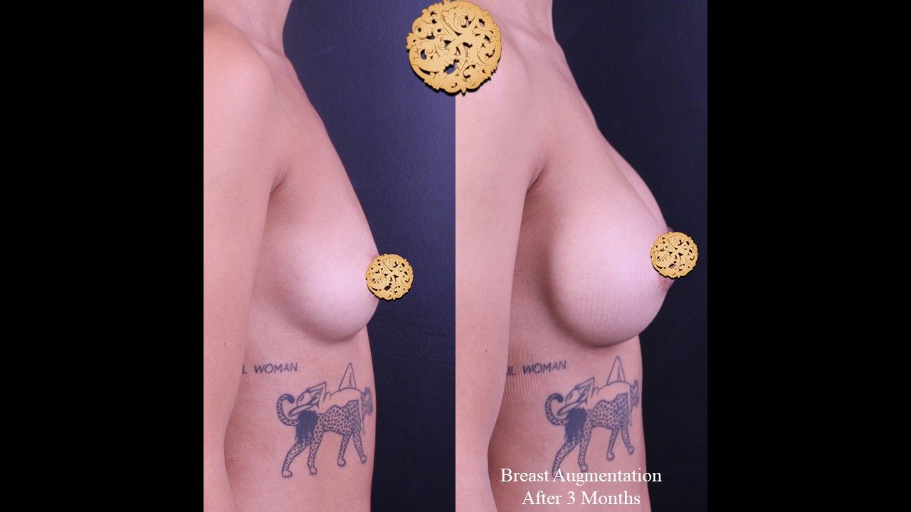 Breast Augmentation Before & After