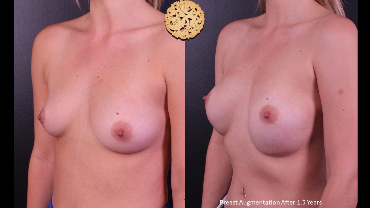 Breast Augmentation Before & After