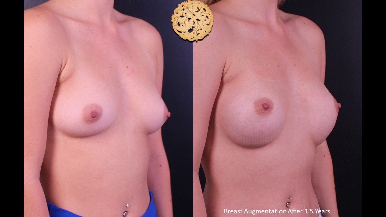 Breast Augmentation Before & After