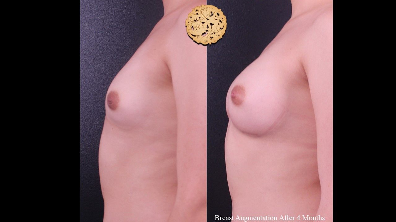 Breast Augmentation Before & After