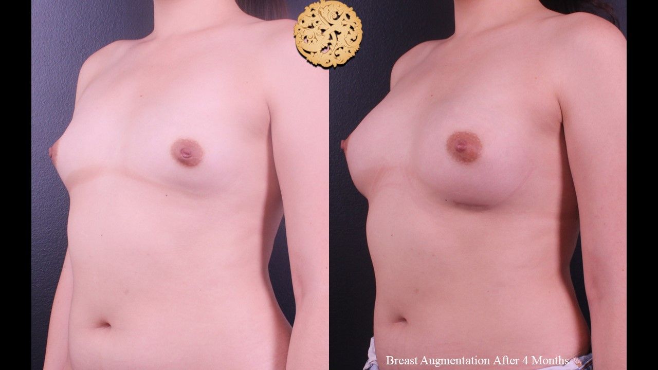 Breast Augmentation Before & After