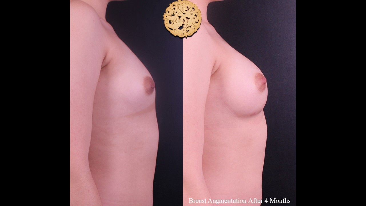 Breast Augmentation Before & After