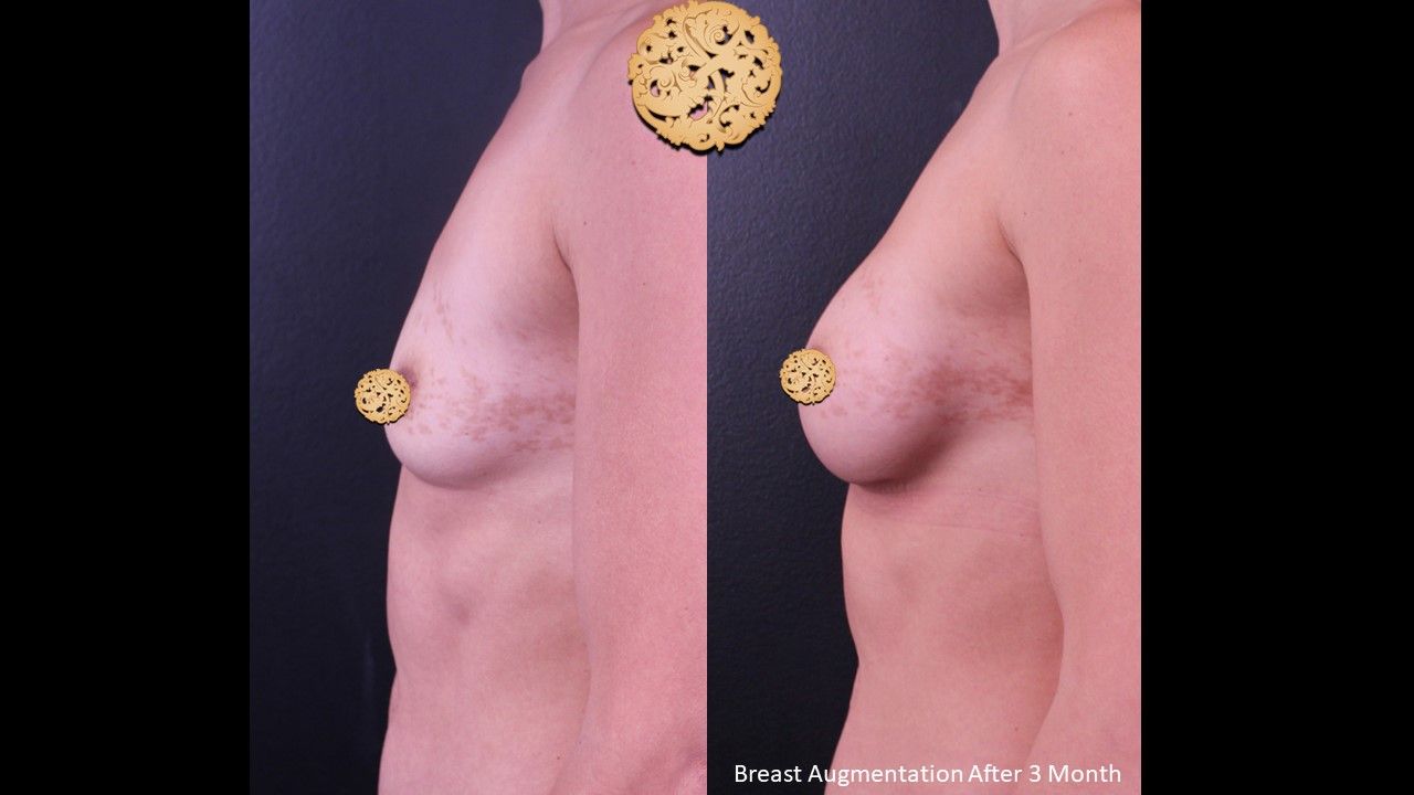 Breast Augmentation Before & After
