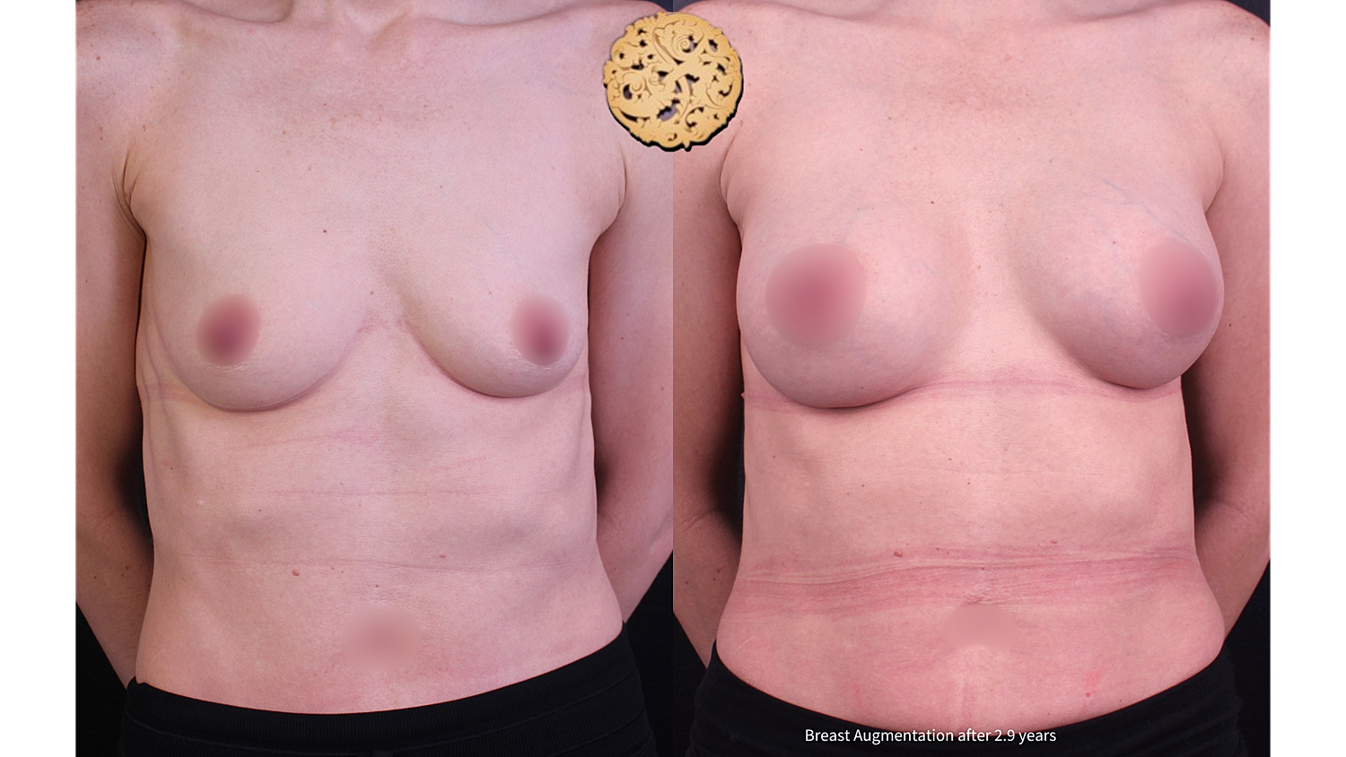 Breast augmentation results after 2.9 years.