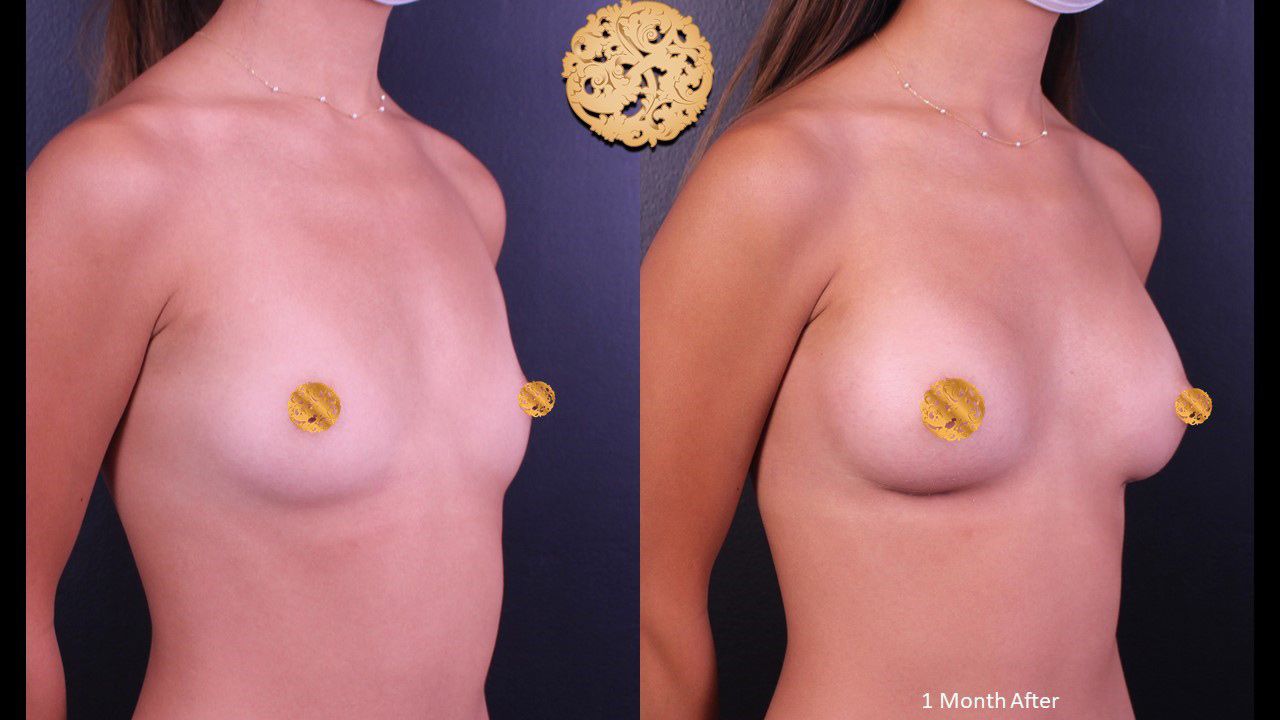 Breast Augmentation Before & After