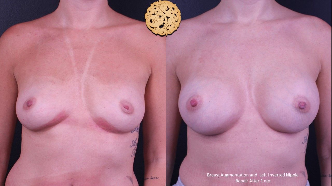Breast Augmentation Before & After