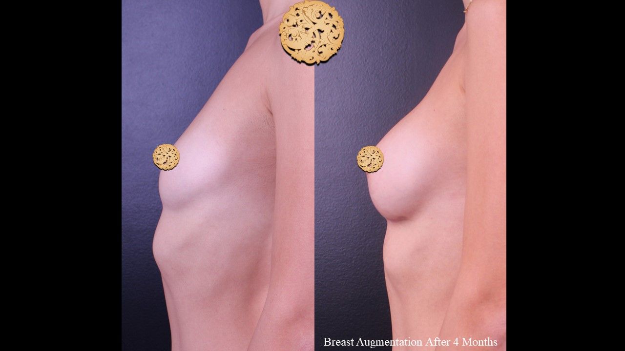 Breast Augmentation Before & After