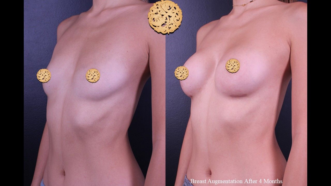 Breast Augmentation Before & After