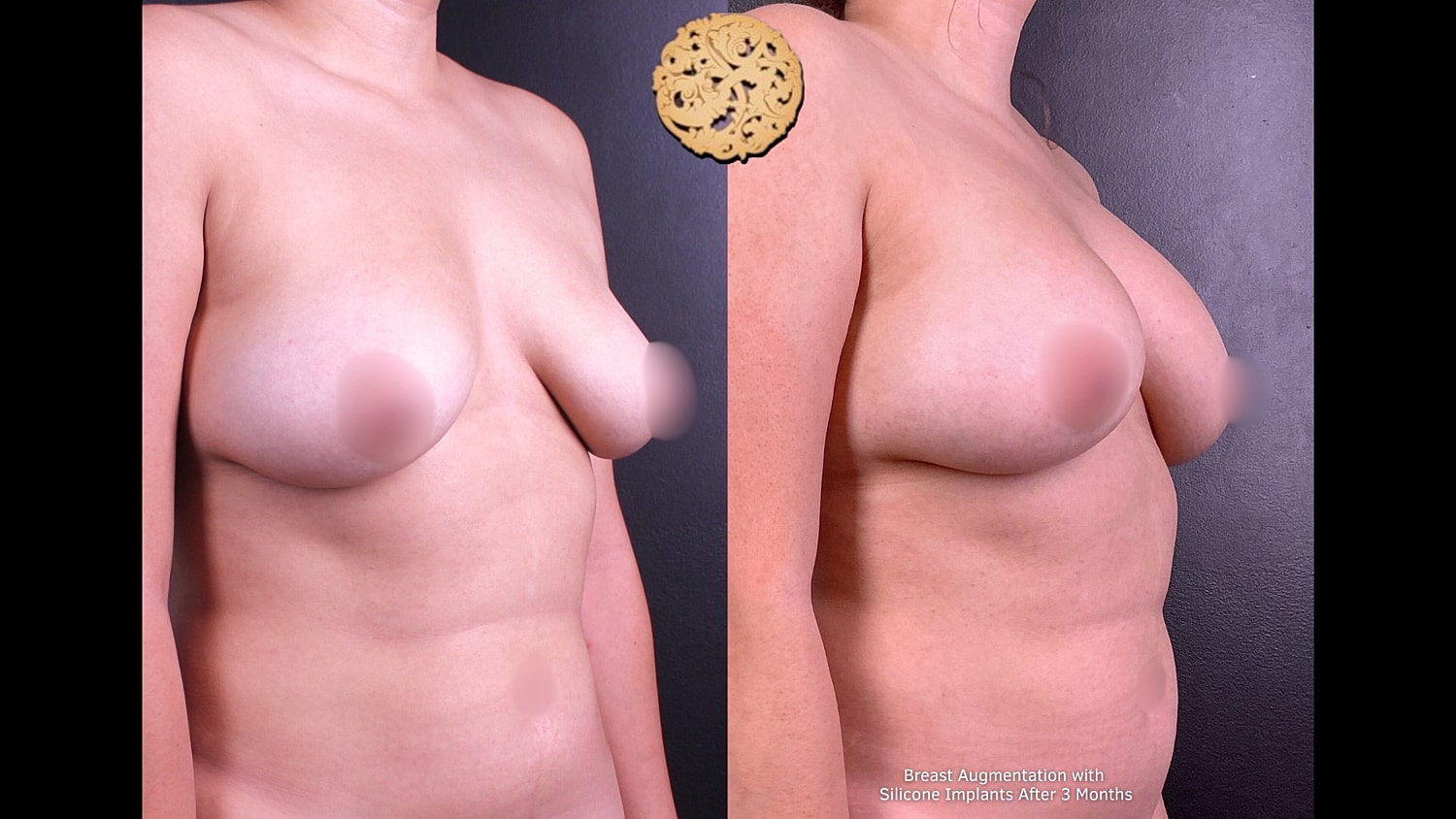 Breast Augmentation with Silicone Implants after 3 months