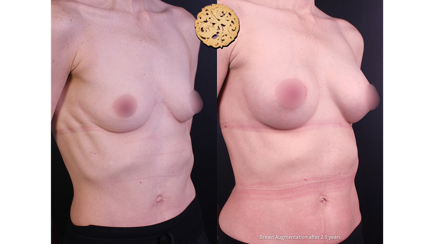 Breast augmentation results before and after surgery.
