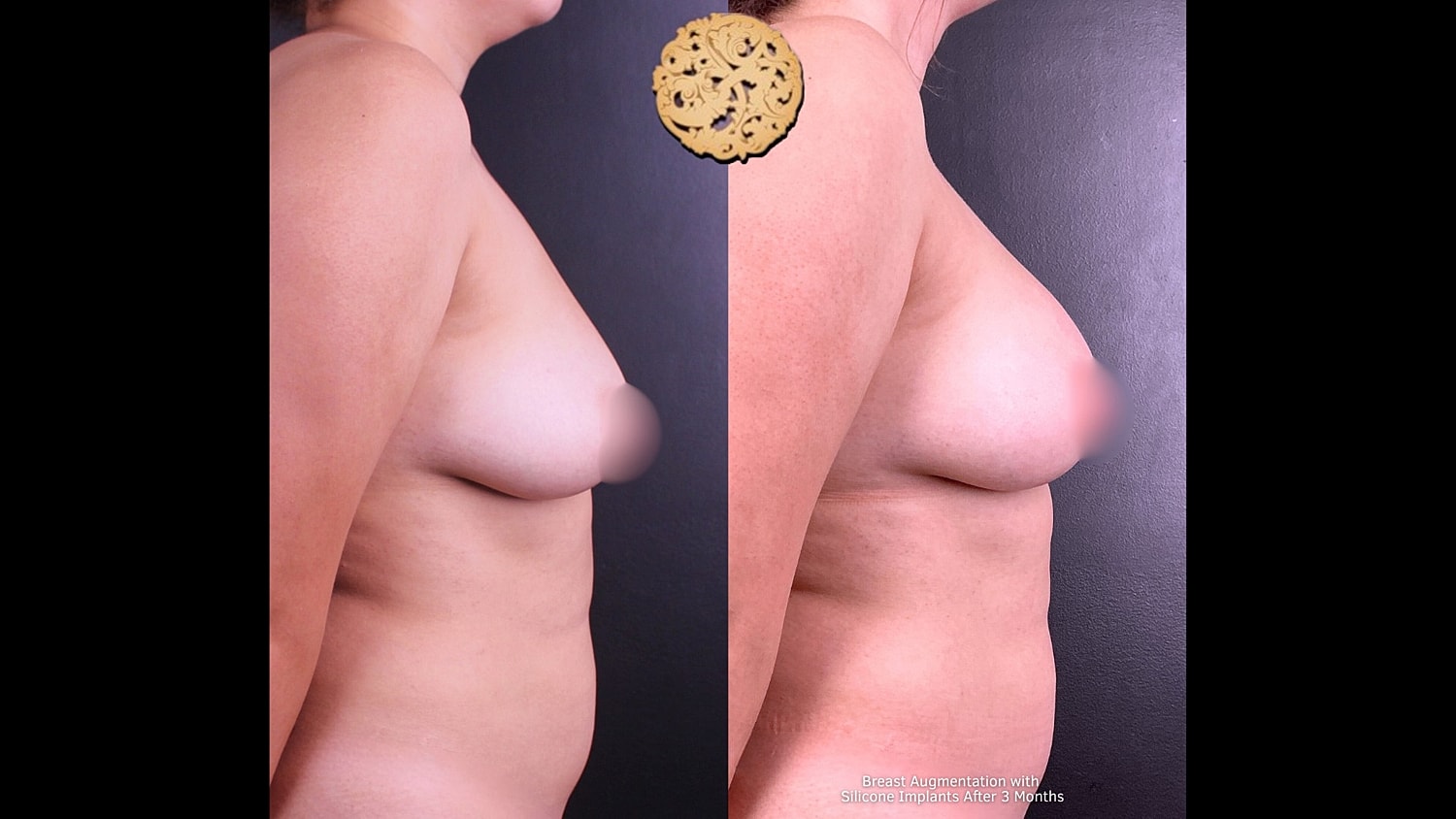 Before and after breast augmentation comparison image.