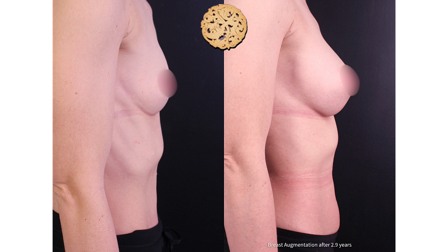 Breast augmentation results after two years.