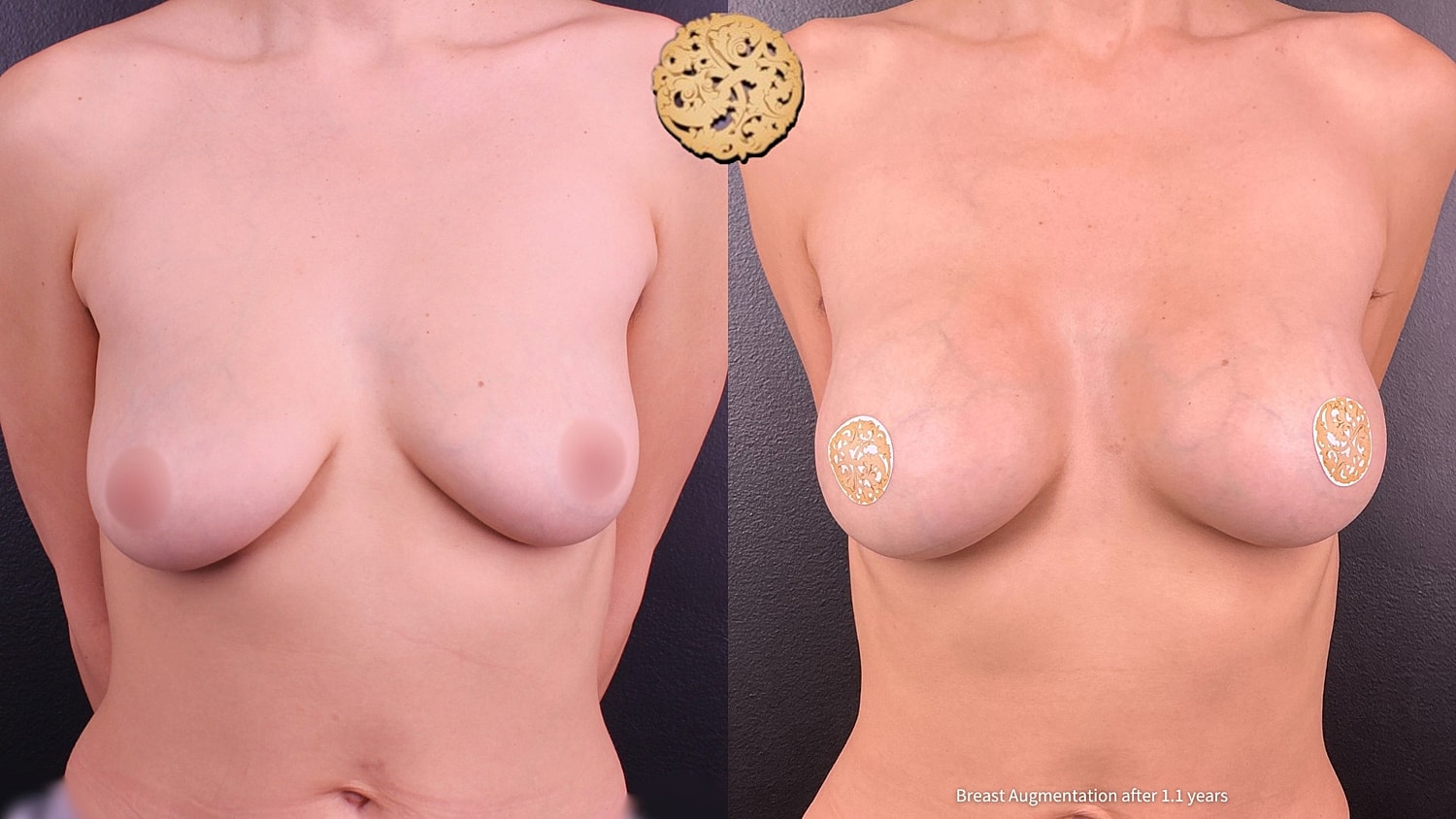 Breast Augmentation Before & After