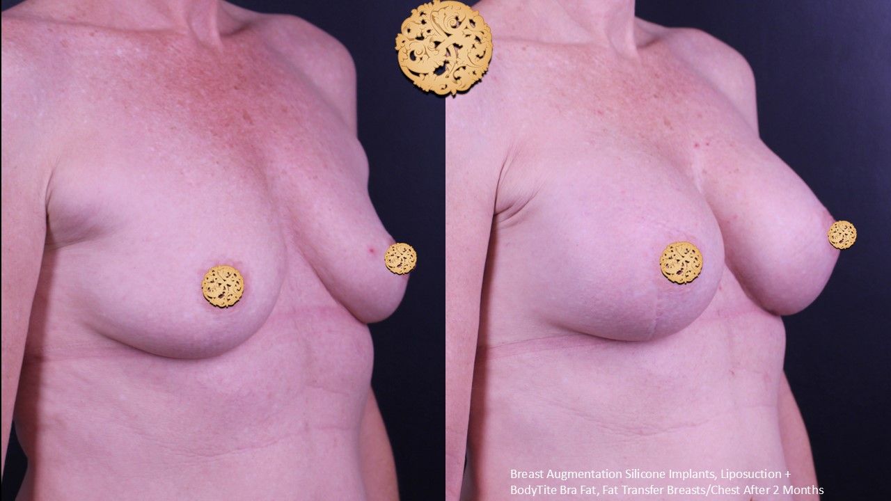 Breast Augmentation Before & After