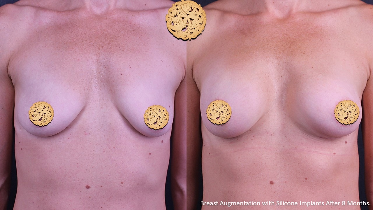 Breast augmentation results after eight months.