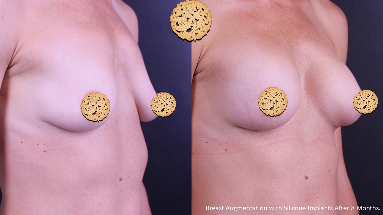 Breast augmentation before and after comparison image
