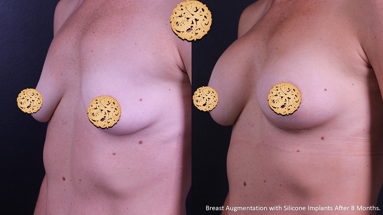Breast augmentation results after eight months.