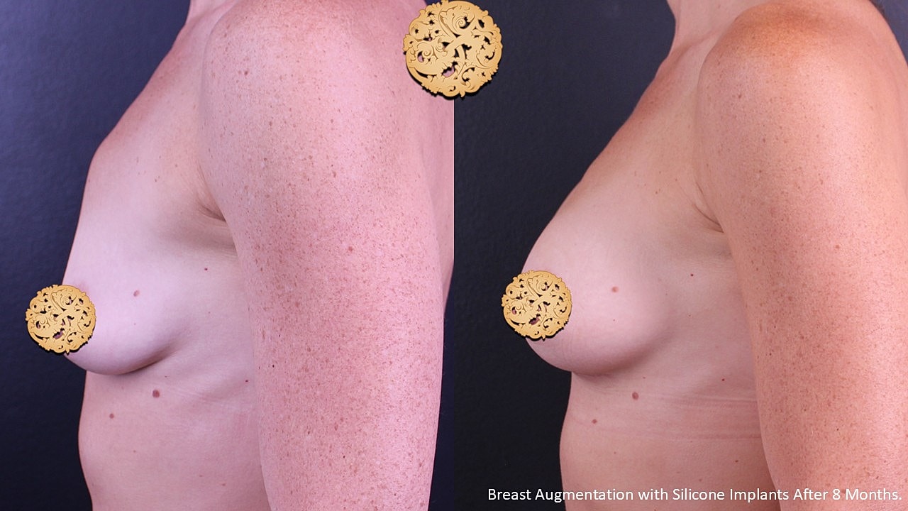 Breast augmentation results after eight months.