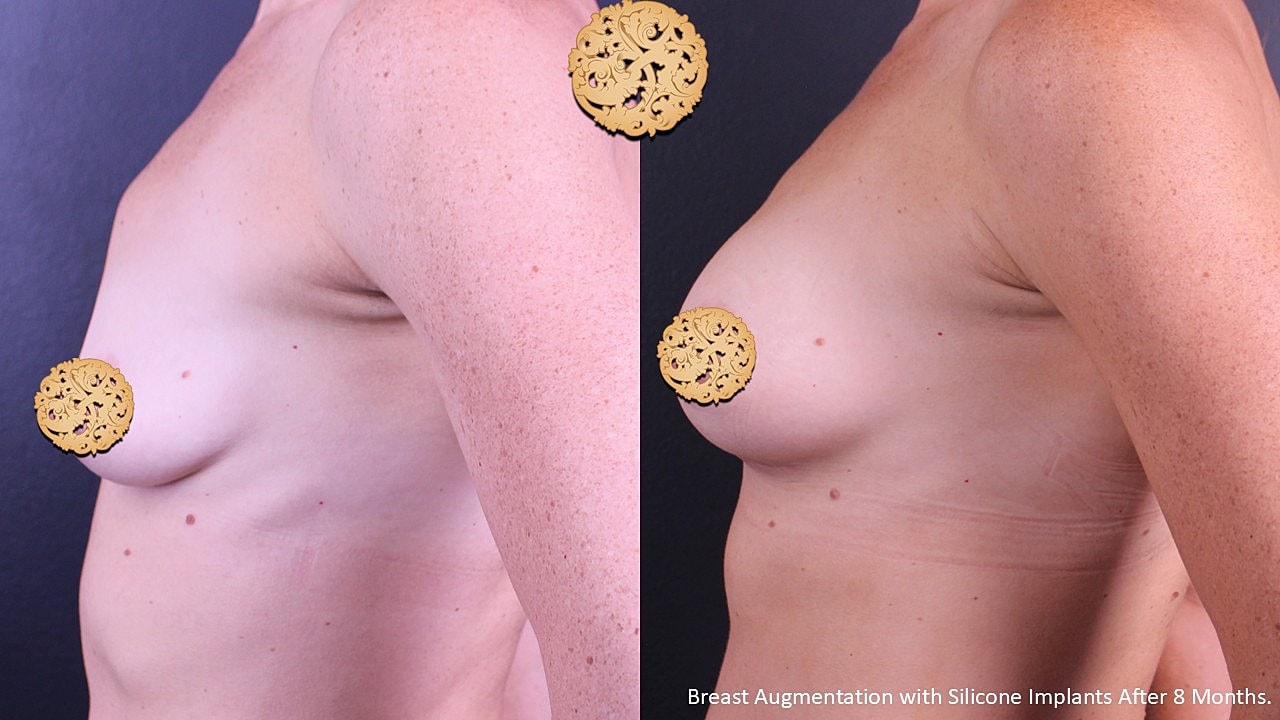Before and after breast augmentation results comparison.