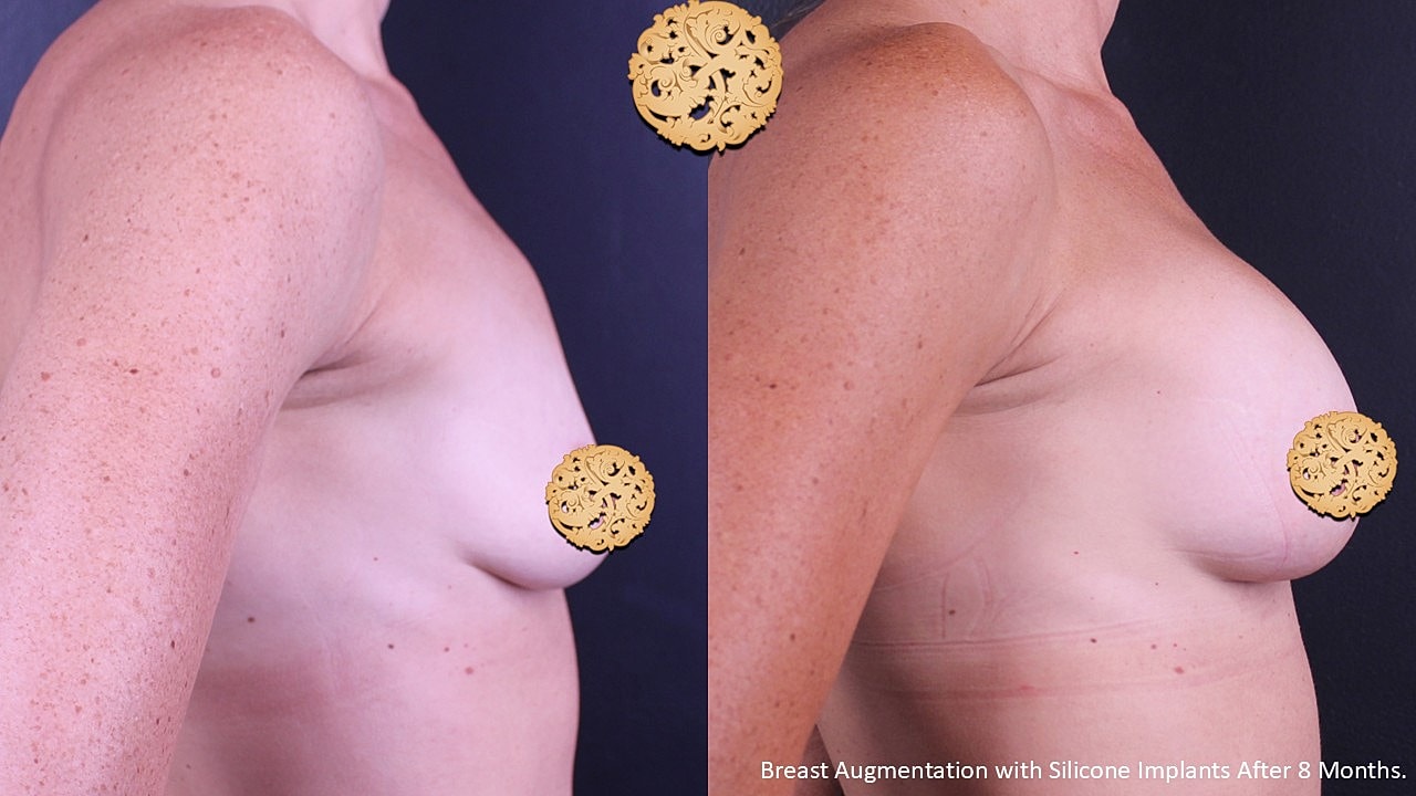 Before and after breast augmentation comparison.