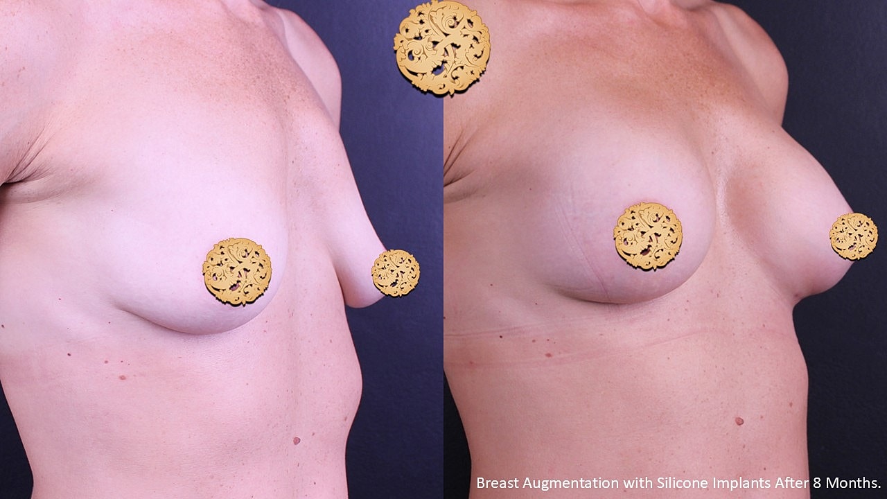Breast augmentation before and after surgery.